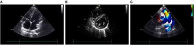 Case Report: A Rare Syncope Case Caused by Abernethy II and a Review of the Literature